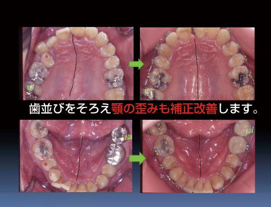 歯並びをそろえ顎の歪みも補正改善します